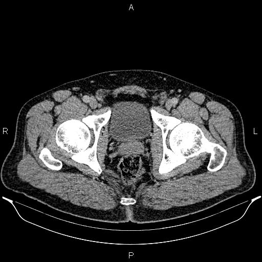Acute appendicitis (Radiopaedia 84780-100240 Axial C+ portal venous phase 107).jpg