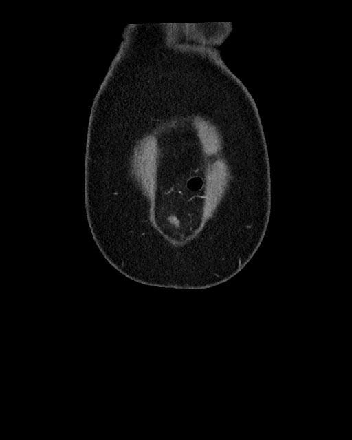 Acute appendicitis - large appendicoliths (Radiopaedia 61805-69820 Coronal C+ portal venous phase 11).jpg
