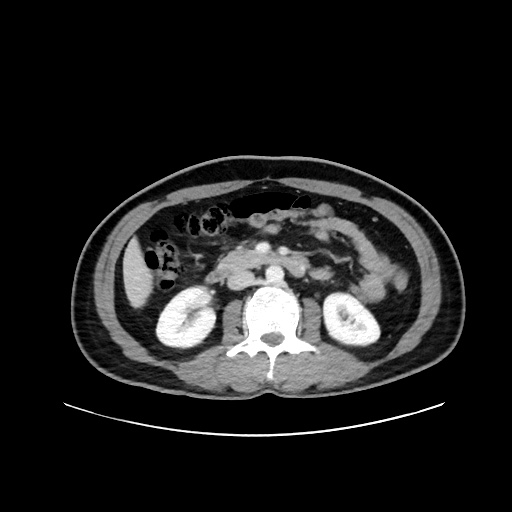 Acute appendicitis and COVID 19 pneumonia (Radiopaedia 76604-88380 Axial C+ portal venous phase 35).jpg