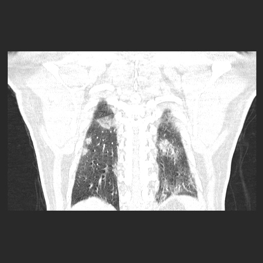Acute appendicitis and COVID 19 pneumonia (Radiopaedia 76604-88380 G 54).jpg