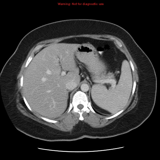 File:Acute appendicitis complicated by ovarian vein thrombophlebitis (Radiopaedia 16172-15851 Axial C+ portal venous phase 24).jpg
