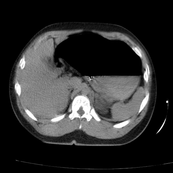 Acute aspiration pneumonitis (Radiopaedia 33605-34703 Axial non-contrast 82).jpg