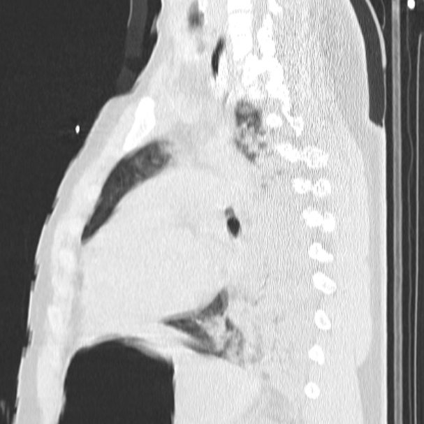 Acute aspiration pneumonitis (Radiopaedia 33605-34703 Sagittal lung window 53).jpg