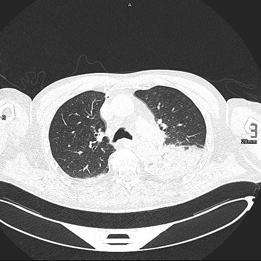 Acute aspiration pneumonitis (Radiopaedia 55642-62166 Axial lung window 60).jpg