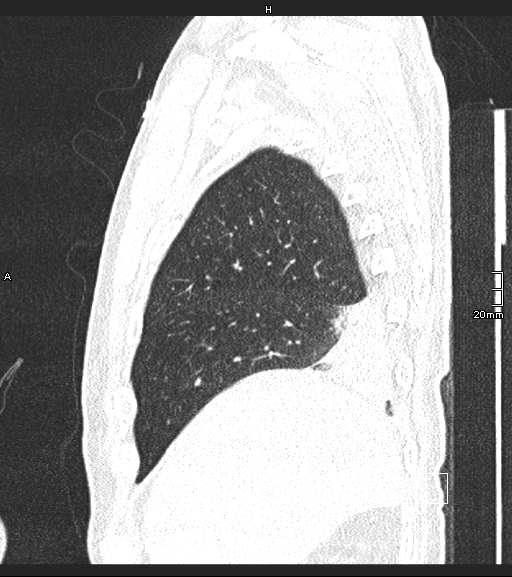 Acute aspiration pneumonitis (Radiopaedia 55642-62166 Sagittal lung window 130).jpg