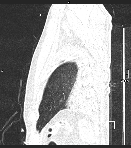 File:Acute aspiration pneumonitis (Radiopaedia 55642-62166 Sagittal lung window 8).jpg