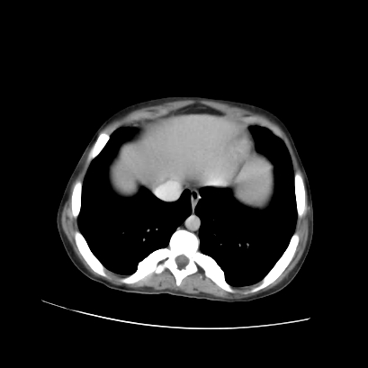 File:Acute calculous cholecystitis in patient with osteopetrosis (Radiopaedia 77871-90159 Axial C+ portal venous phase 16).jpg