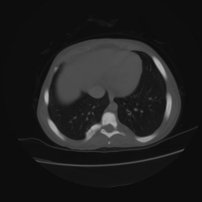 File:Acute calculous cholecystitis in patient with osteopetrosis (Radiopaedia 77871-90159 Axial bone window 3).jpg