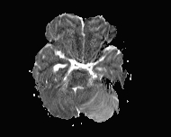 File:Acute cerebellar ataxia (Radiopaedia 61487-69446 Axial ADC 5).jpg