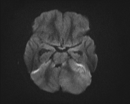 File:Acute cerebellar ataxia (Radiopaedia 61487-69446 Axial DWI 6).jpg