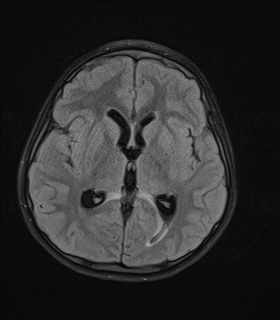 File:Acute cerebellar ataxia (Radiopaedia 61487-69446 Axial FLAIR 11).jpg