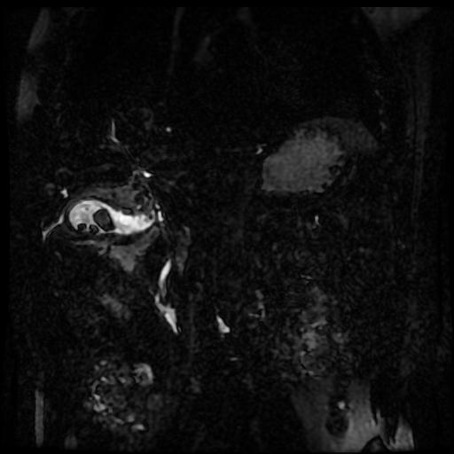 Acute cholecystitis and biliary hamartomas (Radiopaedia 86231-102240 E 60).jpg