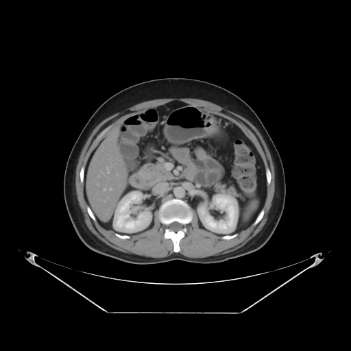 File:Acute complicated calculous cholecystitis (Radiopaedia 55202-61587 Axial C+ delayed 40).jpg