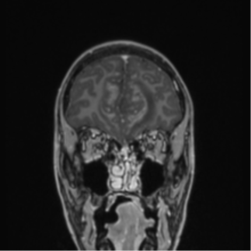 File:Acute disseminated encephalomyelitis (ADEM) (Radiopaedia 65319-74349 Coronal T1 C+ 52).png