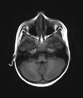 File:Acute disseminating encephalomyelitis with bilateral optic neuritis (Radiopaedia 79676-92886 Axial T1 6).jpg