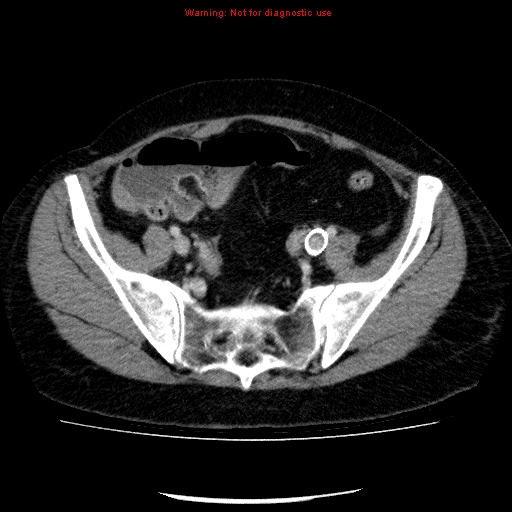 Acute gangrenous cholecystitis (Radiopaedia 10123-10661 Axial C+ portal venous phase 81).jpg