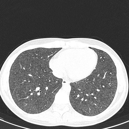 File:Acute hypersensitivity pneumonitis (Radiopaedia 85293-100870 Axial lung window 85).jpg