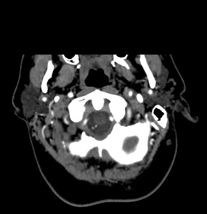 Acute internal carotid artery dissection (Radiopaedia 53541-59630 Axial C+ arterial phase 4).jpg