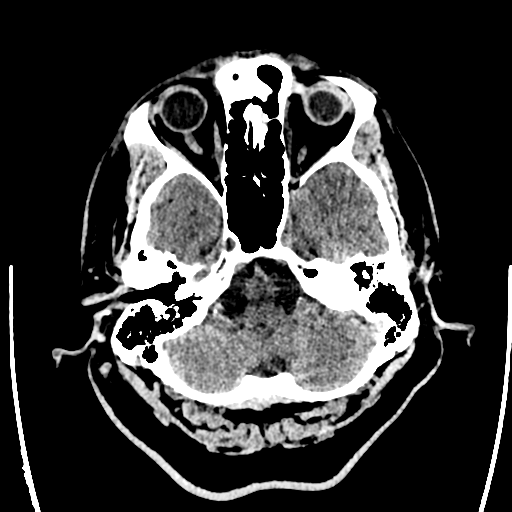 File:Acute left middle cerebral artery territory ischemic stroke (Radiopaedia 35688-37223 Axial non-contrast 13).png