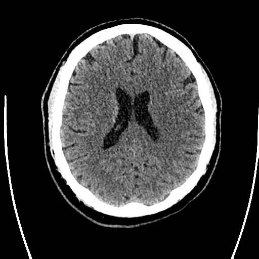 Acute left middle cerebral artery territory ischemic stroke (Radiopaedia 35688-37223 Axial non-contrast 50).png