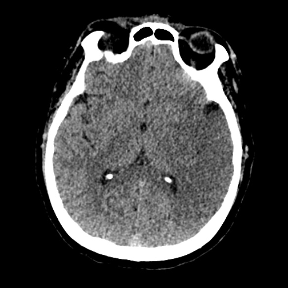 Acute middle cerebral artery territory infarct (Radiopaedia 52380-58283 Axial non-contrast 52).jpg
