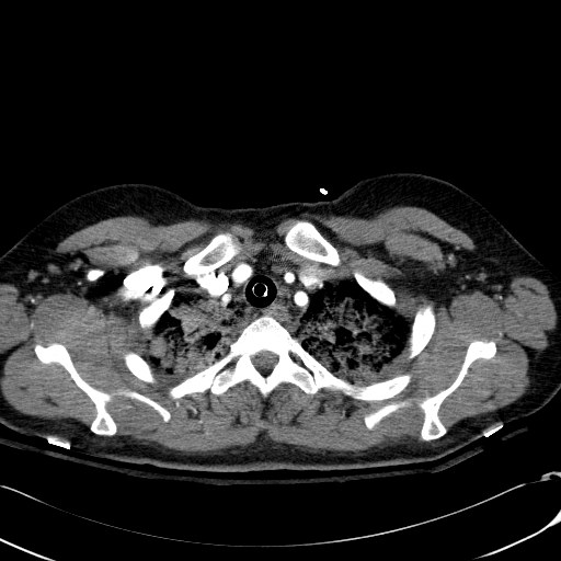 File:Acute myocardial infarction in CT (Radiopaedia 39947-42415 Axial C+ arterial phase 19).jpg