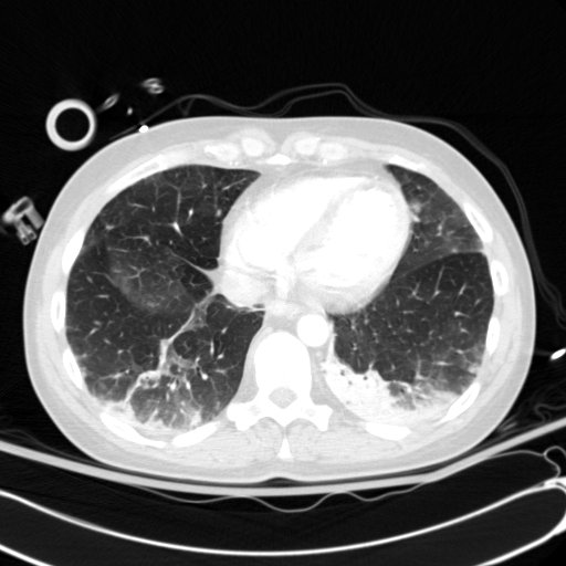 Acute myocardial infarction in CT (Radiopaedia 39947-42415 Axial lung window 99).jpg