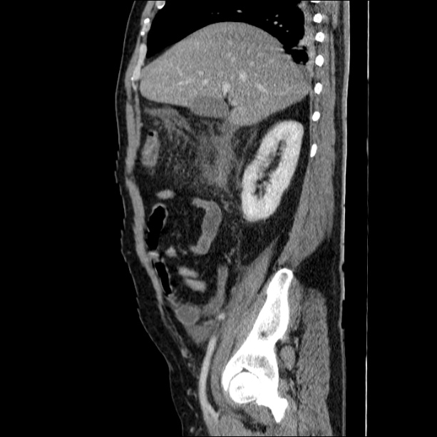 Acute pancreatitis (Radiopaedia 26663-26813 Sagittal C+ portal venous phase 23).jpg