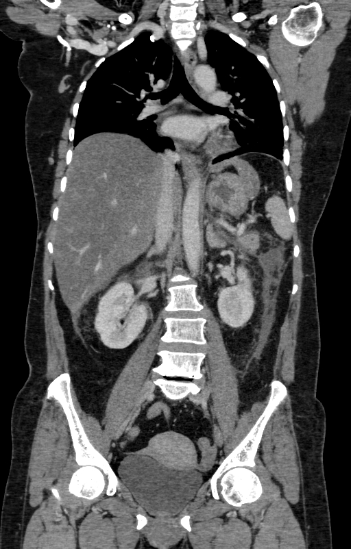 Acute pancreatitis (Radiopaedia 80007-93285 Coronal C+ portal venous phase 76).jpg