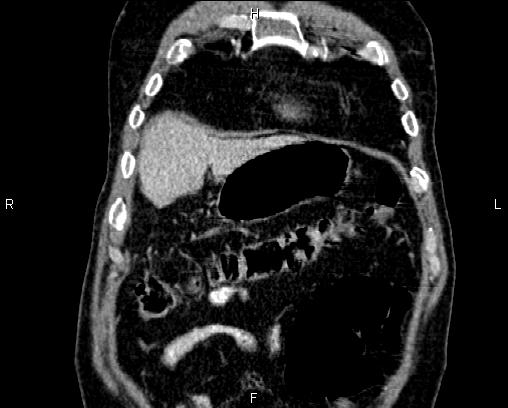 Acute pancreatitis (Radiopaedia 85146-100701 Coronal C+ portal venous phase 9).jpg