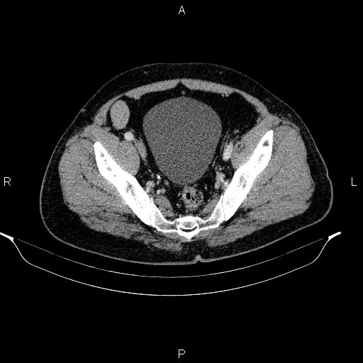 Acute pancreatitis (Radiopaedia 85390-101010 Axial C+ portal venous phase 91).jpg