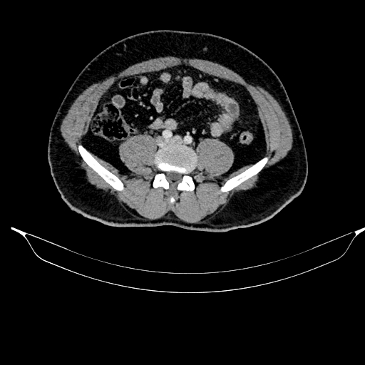 File:Acute pancreatitis (Radiopaedia 87428-103757 Axial C+ portal venous phase 66).jpg