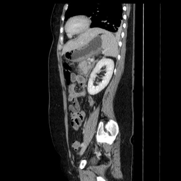 Acute pancreatitis - Balthazar C (Radiopaedia 26569-26714 Sagittal C+ portal venous phase 47).jpg