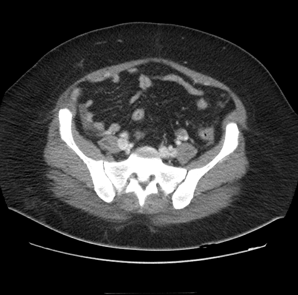 File:Acute pancreatitis - Balthazar E (Radiopaedia 29016-29377 Axial C+ portal venous phase 54).png