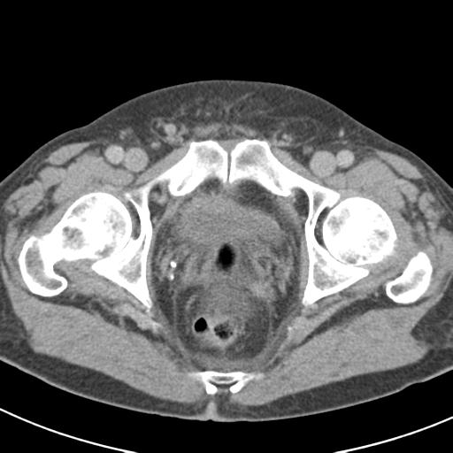 Acute pancreatitis and walled-off necrosis (Radiopaedia 29888-30403 Axial C+ delayed 80).jpg