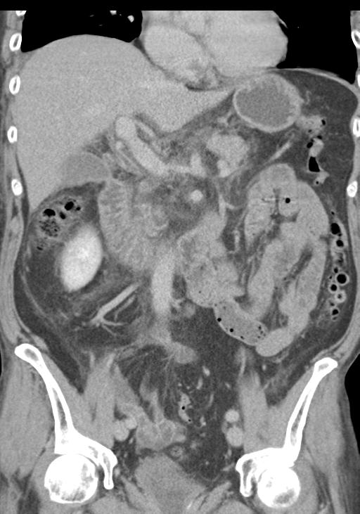 Acute pancreatitis and walled-off necrosis (Radiopaedia 29888-30403 E 28).jpg