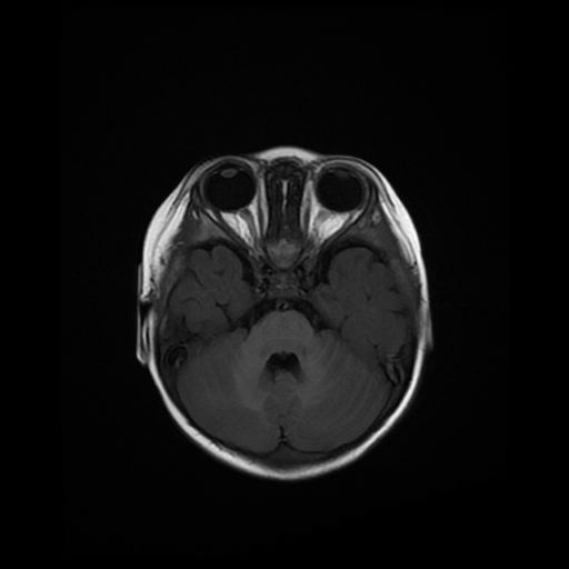 File:Acute phase of hemiconvulsion-hemiplegia epilepsy syndrome (Radiopaedia 29309-29745 Axial T1 17).jpg