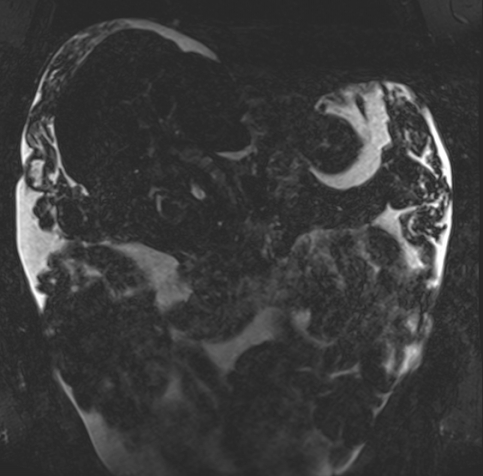 Acute portal vein thrombosis (Radiopaedia 73198-83925 Coronal Heavily T2 thin cuts 25).jpg