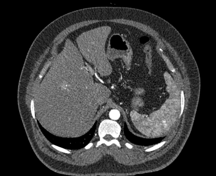 Acute pulmonary embolism with pulmonary infarcts (Radiopaedia 77688-89908 Axial C+ CTPA 69).jpg