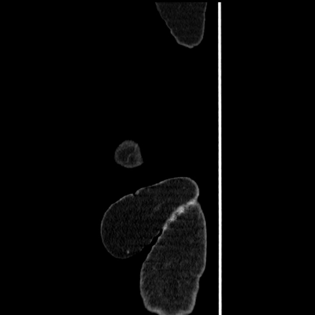Acute pyelonephritis (Radiopaedia 25657-25837 Sagittal renal parenchymal phase 83).jpg