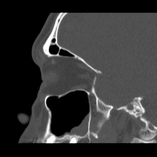 Acute sinusitis (Radiopaedia 23161-23215 Sagittal bone window 22).jpg