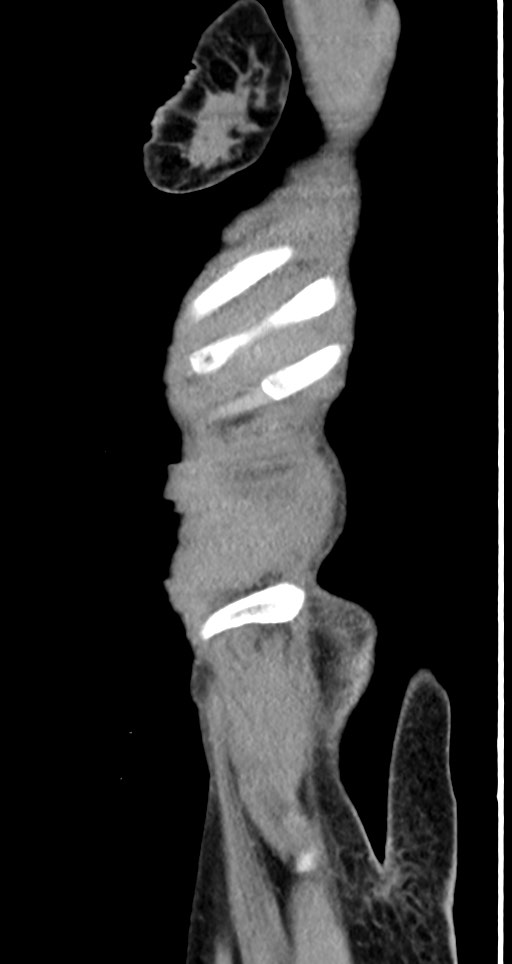 Acute small bowel (ileal) volvulus (Radiopaedia 71740-82139 Sagittal C+ portal venous phase 150).jpg