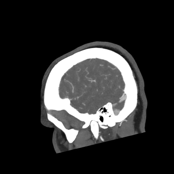 File:Acute subarachnoid hemorrhage and accessory anterior cerebral artery (Radiopaedia 69231-79009 Sagittal C+ arterial phase 14).jpg