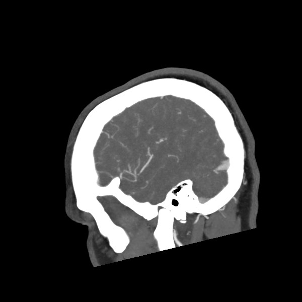 Acute subarachnoid hemorrhage and accessory anterior cerebral artery (Radiopaedia 69231-79009 Sagittal C+ arterial phase 16).jpg