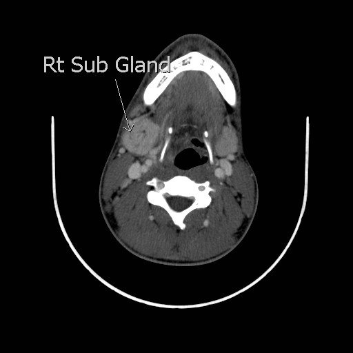 File:Acute submandibular sialadenitis secondary to ductal stone (Radiopaedia 27999-28267 Axial C+ delayed 27).jpg