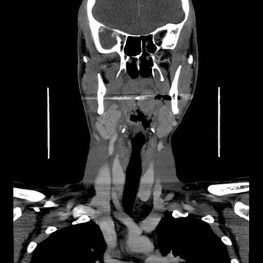 File:Acute submandibular sialadenitis secondary to ductal stone (Radiopaedia 27999-28267 D 26).jpg