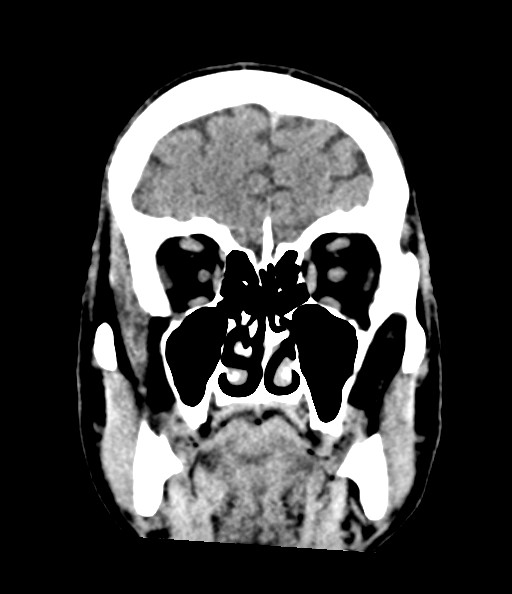 Acute superior cerebellar artery territory infarct (Radiopaedia 84104-99359 Coronal non-contrast 30).jpg