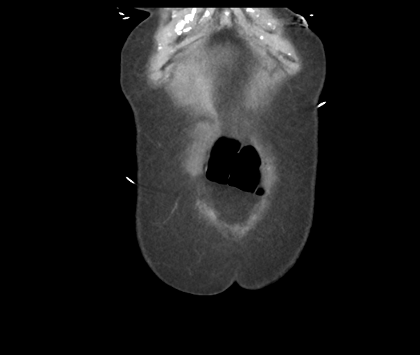 Acute superior mesenteric artery occlusion (Radiopaedia 43926-47418 Coronal C+ portal venous phase 7).png