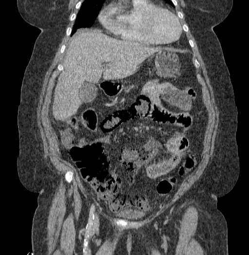 Acute superior mesenteric artery occlusion (Radiopaedia 51288-56960 Coronal C+ portal venous phase 29).jpg