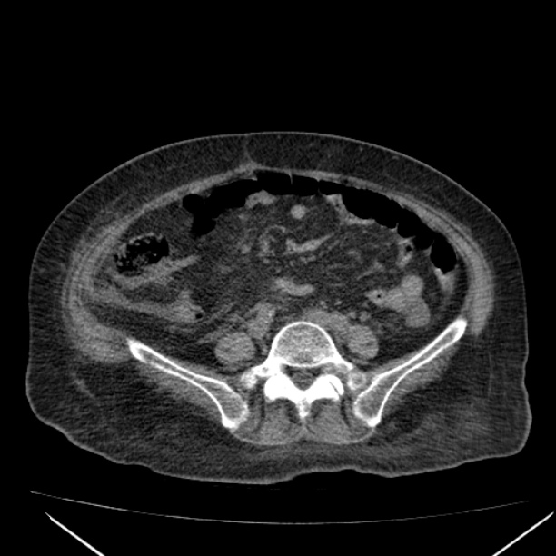 Acute tubular necrosis (Radiopaedia 28077-28334 Axial non-contrast 45).jpg
